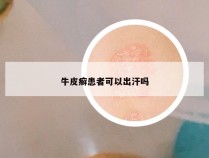 牛皮癣患者可以出汗吗