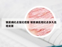 银屑病红点变红疙瘩 银屑病出现红点多久出现皮屑