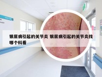 银屑病引起的关节炎 银屑病引起的关节炎找哪个科看