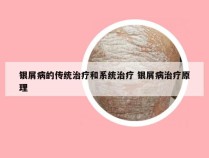 银屑病的传统治疗和系统治疗 银屑病治疗原理