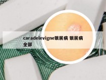 caradelevigne银屑病 银屑病全部