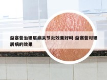 益塞普治银屑病关节炎效果好吗 益赛普对银屑病的效果