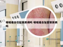 喉咙痛会引起银屑病吗 喉咙痛会加重银屑病吗