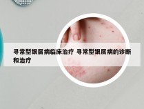寻常型银屑病临床治疗 寻常型银屑病的诊断和治疗