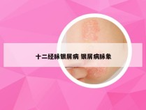 十二经脉银屑病 银屑病脉象