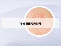 牛皮癣图片传染吗