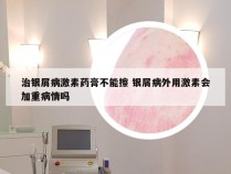 治银屑病激素药膏不能擦 银屑病外用激素会加重病情吗