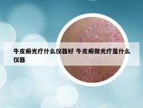 牛皮癣光疗什么仪器好 牛皮癣做光疗是什么仪器