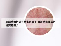 银屑病如何调节免疫力低下 银屑病吃什么药提高免疫力
