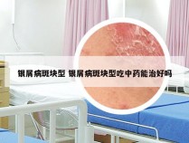 银屑病斑块型 银屑病斑块型吃中药能治好吗
