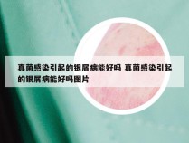 真菌感染引起的银屑病能好吗 真菌感染引起的银屑病能好吗图片