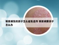 银屑病生的孩子怎么避免遗传 银屑病要孩子怎么办