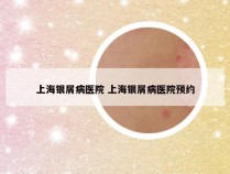 上海银屑病医院 上海银屑病医院预约