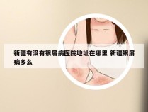 新疆有没有银屑病医院地址在哪里 新疆银屑病多么