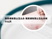 银屑病有裂口怎么办 银屑病有裂口怎么办用什么药