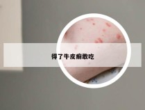 得了牛皮癣敢吃