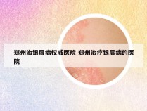 郑州治银屑病权威医院 郑州治疗银屑病的医院