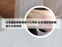 红皮病型银屑病有什么特征 红皮病型银屑病有什么特征吗