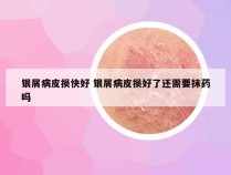 银屑病皮损快好 银屑病皮损好了还需要抹药吗