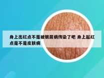 身上出红点不是被银屑病传染了吧 身上起红点是不是皮肤病