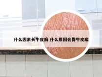 什么因素长牛皮癣 什么原因会得牛皮廨