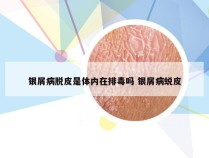 银屑病脱皮是体内在排毒吗 银屑病蜕皮