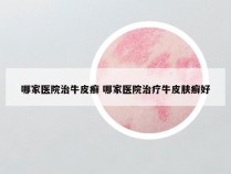 哪家医院治牛皮癣 哪家医院治疗牛皮肤癣好