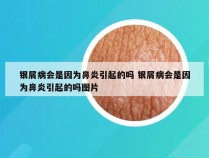 银屑病会是因为鼻炎引起的吗 银屑病会是因为鼻炎引起的吗图片