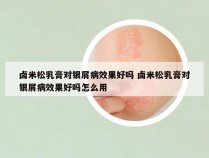 卤米松乳膏对银屑病效果好吗 卤米松乳膏对银屑病效果好吗怎么用
