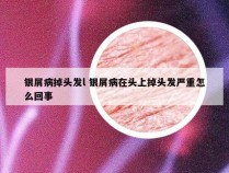 银屑病掉头发l 银屑病在头上掉头发严重怎么回事