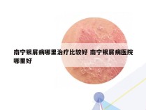南宁银屑病哪里治疗比较好 南宁银屑病医院哪里好