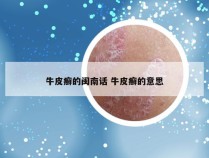 牛皮癣的闽南话 牛皮癣的意思