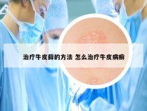 治疗牛皮藓的方法 怎么治疗牛皮病癣