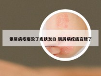 银屑病疙瘩没了皮肤发白 银屑病疙瘩变硬了