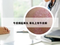 牛皮癣起睾丸 睾丸上有牛皮癣