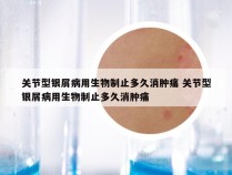 关节型银屑病用生物制止多久消肿痛 关节型银屑病用生物制止多久消肿痛
