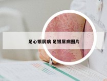 足心银屑病 足银屑病图片