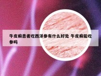 牛皮癣患者吃西洋参有什么好处 牛皮癣能吃参吗