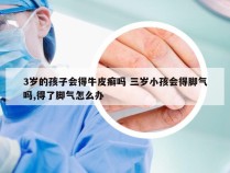 3岁的孩子会得牛皮癣吗 三岁小孩会得脚气吗,得了脚气怎么办