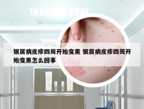 银屑病皮疹四周开始变黑 银屑病皮疹四周开始变黑怎么回事