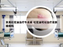 食用红花油治疗牛皮癣 红花油可以治疗皮肤瘙痒吗