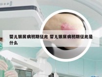 婴儿银屑病初期征兆 婴儿银屑病初期征兆是什么