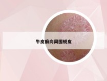牛皮癣向周围蜕皮