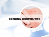 银屑病的情况 银屑病的情况有哪些