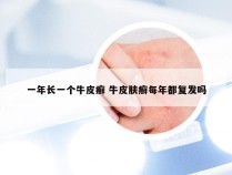 一年长一个牛皮癣 牛皮肤癣每年都复发吗
