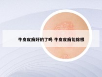 牛皮皮癣好的了吗 牛皮皮癣能除根