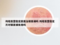 枸地氯雷他定胶囊治银屑病吗 枸地氯雷他定片对银屑病有用吗