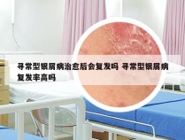 寻常型银屑病治愈后会复发吗 寻常型银屑病复发率高吗