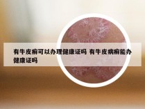 有牛皮癣可以办理健康证吗 有牛皮病癣能办健康证吗