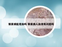 银屑病能现血吗 银屑病人血液有问题吗